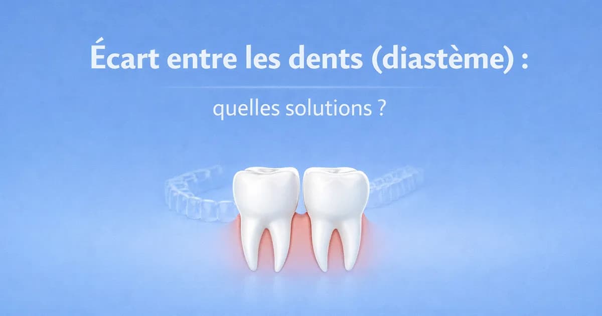 Écart entre les dents (diastème) : quelles solutions ?